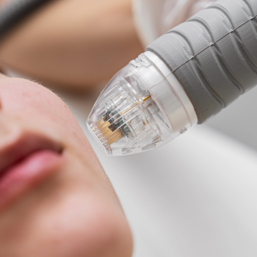 mezoterapia mikroigłowa efekty