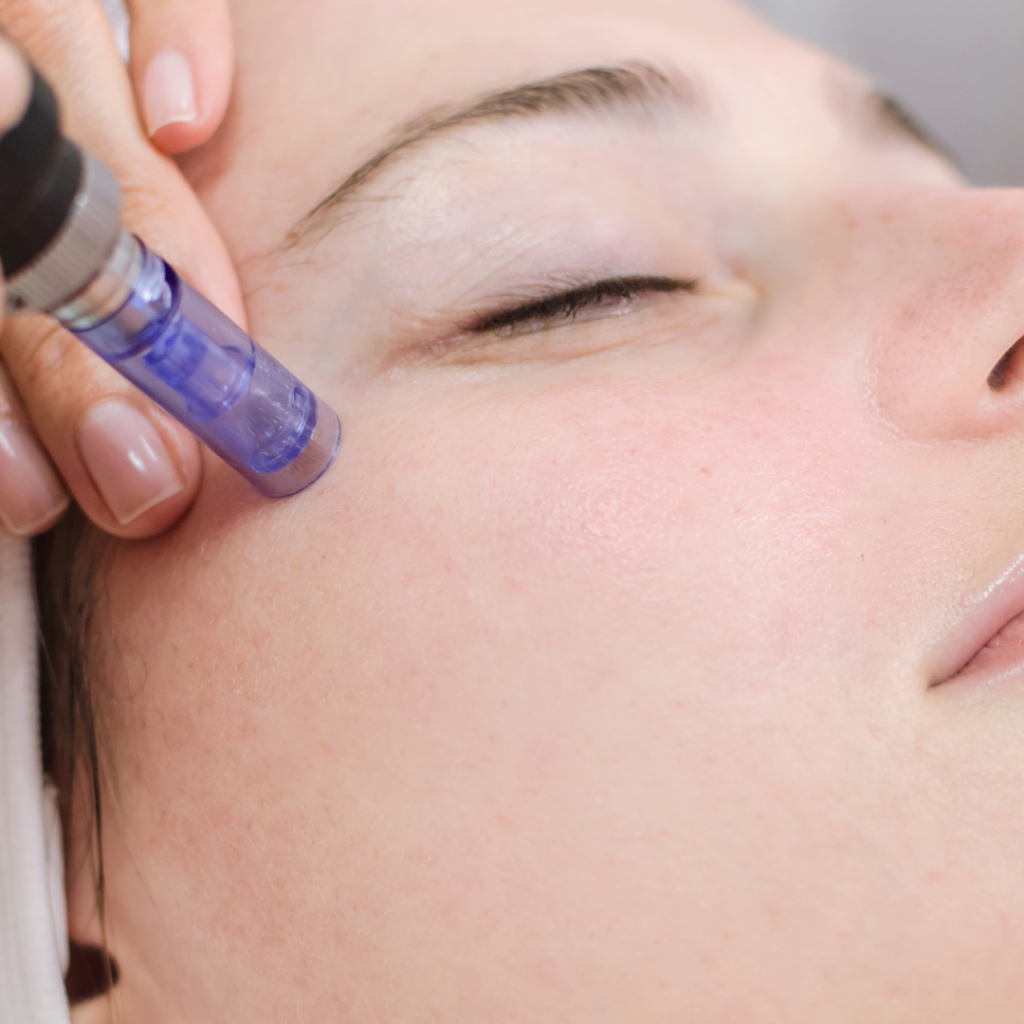 Zabieg mezoterapii mikroigłowej w Poznaniu